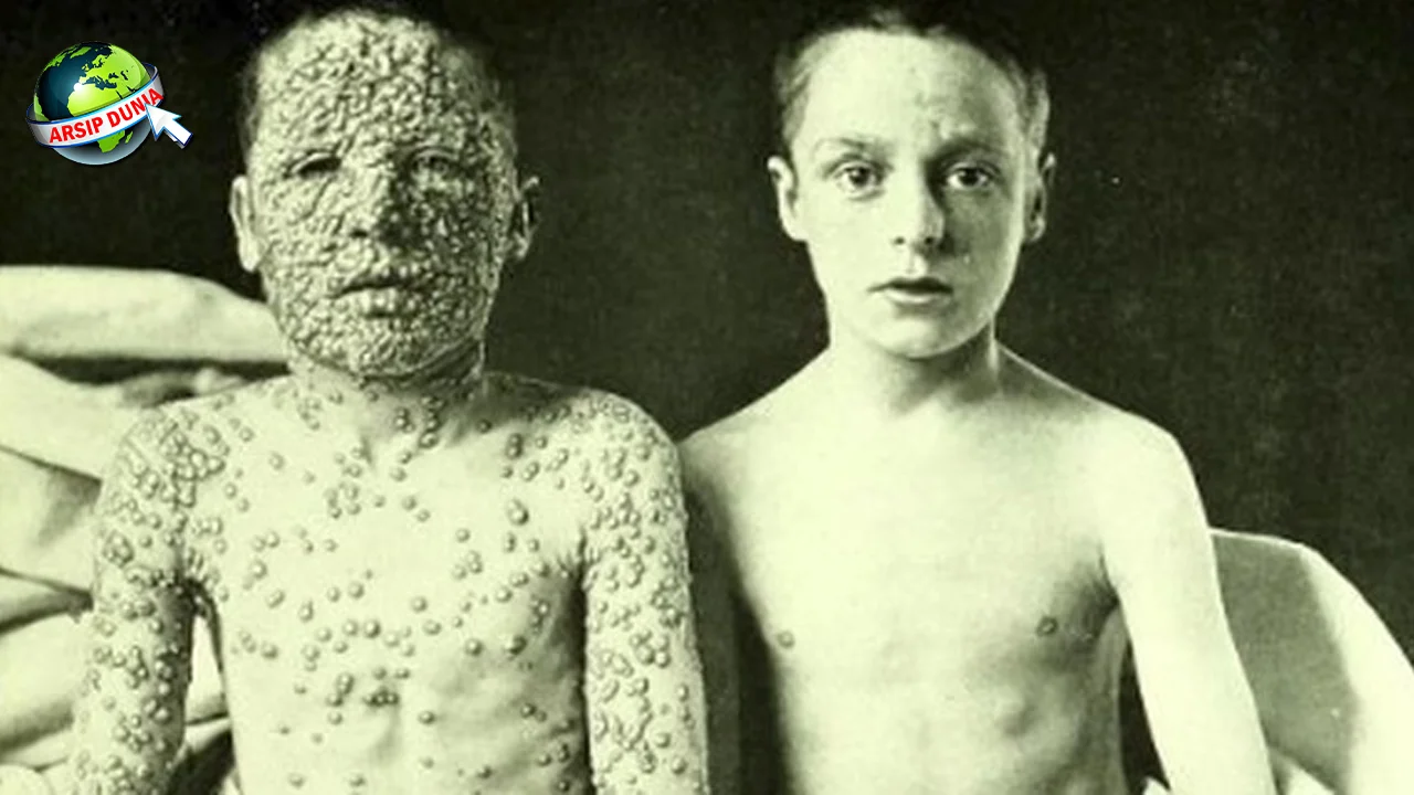 Vaksin Cacar 7 Warisan Abadi Kesehatan Global